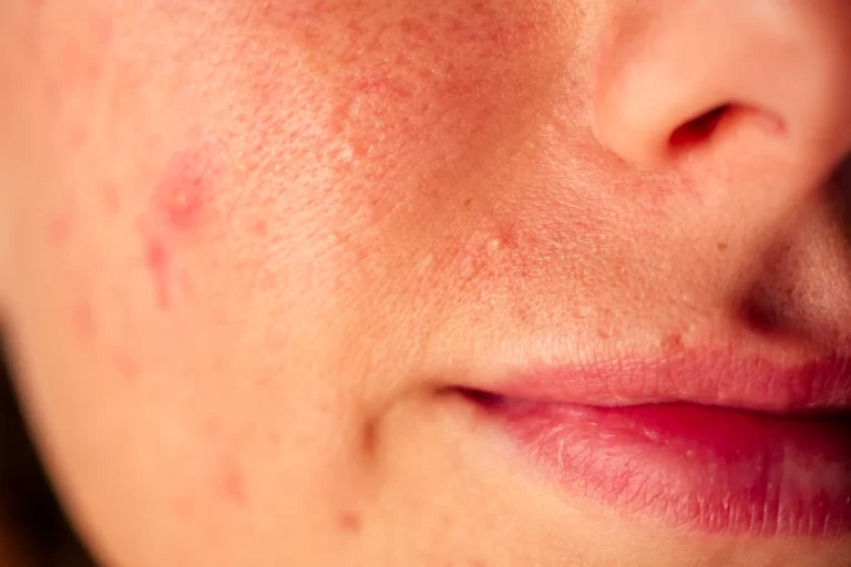 Retinol u lecenju akni